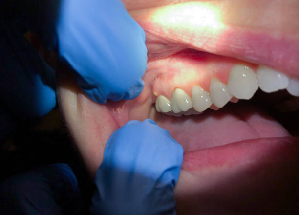 Best Emergency Dental Extractions in Evergreen, CO